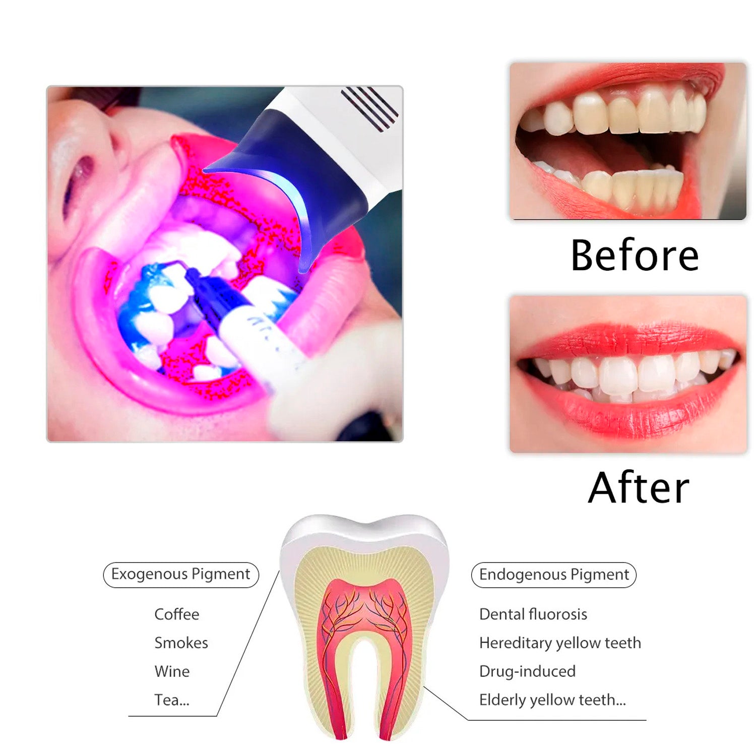Lámpara Aceleradora De Blanqueamiento Dental De Pedestal